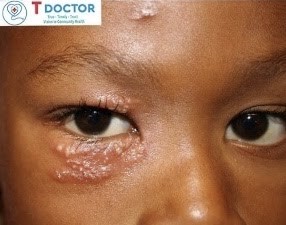 Zona thần kinh nhẹ những điều cần biết 